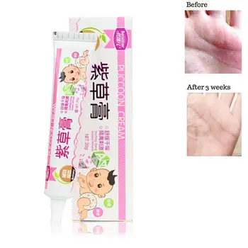 

20g Mosquito Bites Anti-itching Cream Ointment Antibacterial Comfrey Cream Chinese Herbal Medical Plaster Baby Adult Health Care
