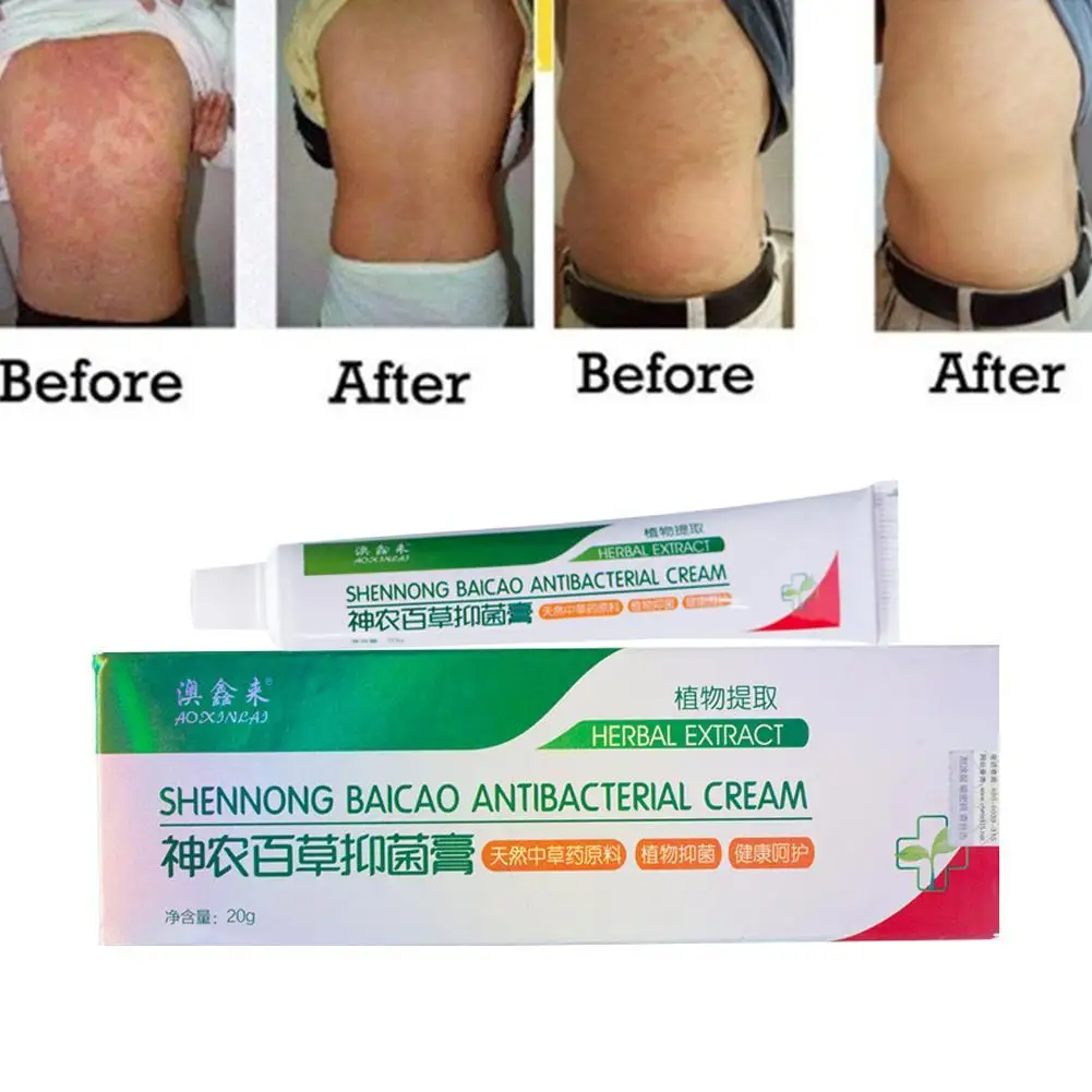 Shenlong крем от псориаза Китайский травяной платырь против дерматит Eczematoid экзема мазь лечение экземы штукатурка по уходу за кожей бактериостатическое