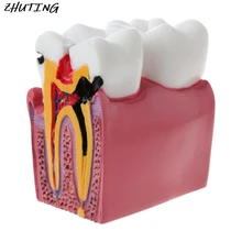 6 раз стоматологический кариес компарация Анатомия зубы модель для стоматологической анатомии лаборатория обучение исследования инструмент исследования