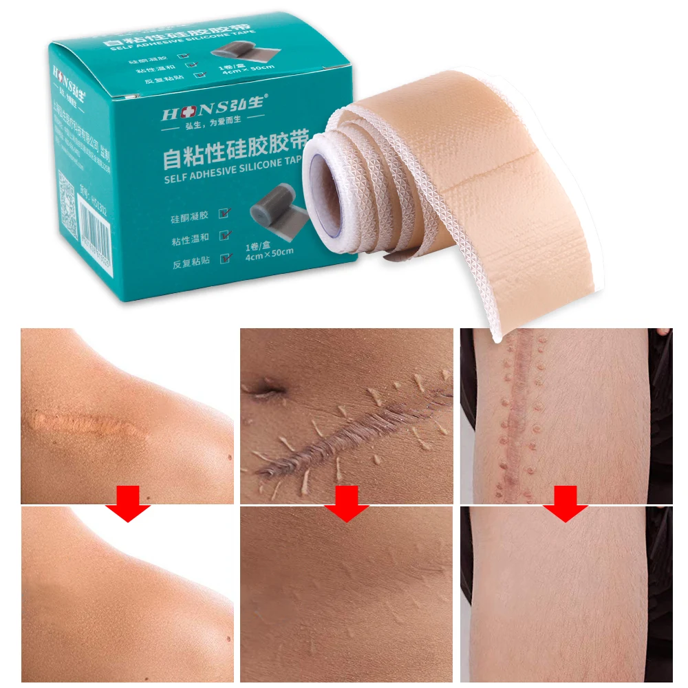 Silicone Scar Removal Sheet Acne Trauma Burn Scar Skin Repair Keloid Silicone Patch Efficient Surgery Caesarean Section Gel