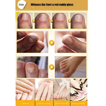 

Useful Fungal Nail Treatment Essence Toe Nail Finger Anti Fungus Infection 30ml U50F