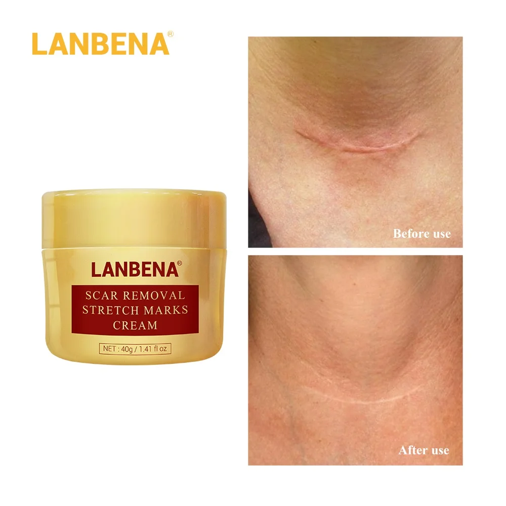 LANBENA крем для удаления шрамов удаление черных точек сужение пор отбеливание