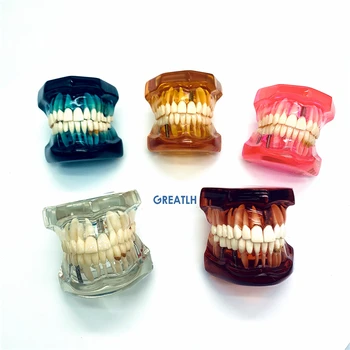 

Dental Pathological Teeth Model teeth imPlant restoration model for dentist learning Teaching Study