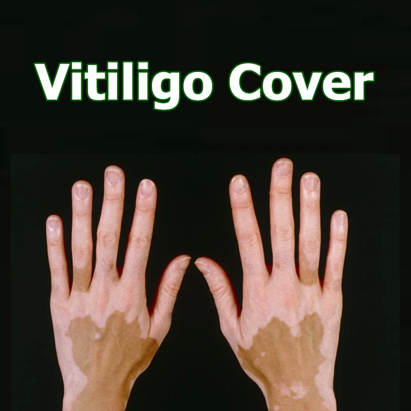 

Cover Vitiligo Patches Waterproof Instant Skin Leucoderma Makeup Coating Concealer Pen on Face Arm Body for Women Men Kids 1pc