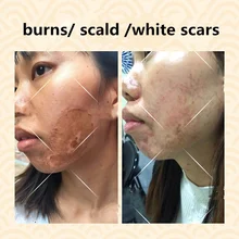 Наборы крема для удаления шрамов, чистая китайская медицина, устраняет воспаления, восстанавливает белые рубцы/ожоги/хирургические рубцы