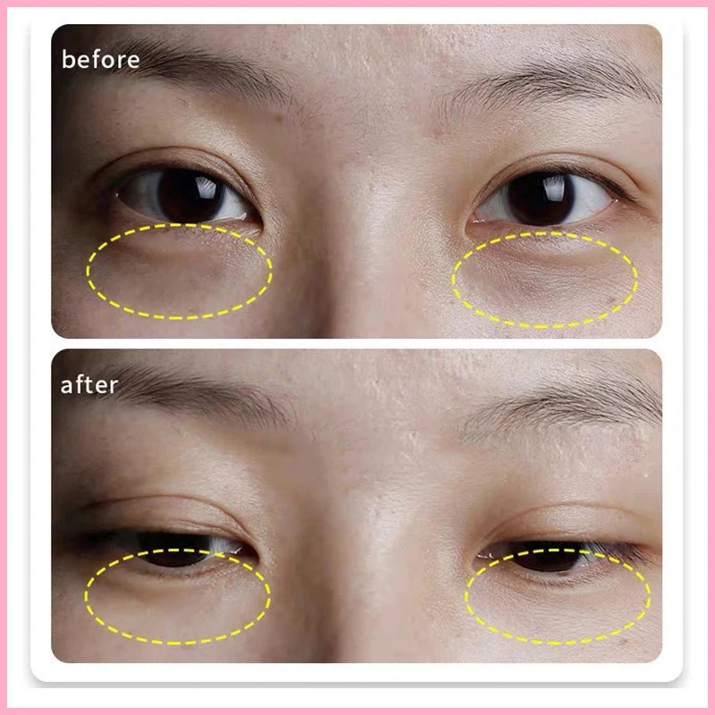 Eye Patches Hyaluronic Acids Microneedle Eye Pads Moisturizing Wrinkles Fine Lines Dark Circles Removal Collagen Eye Mask Patch