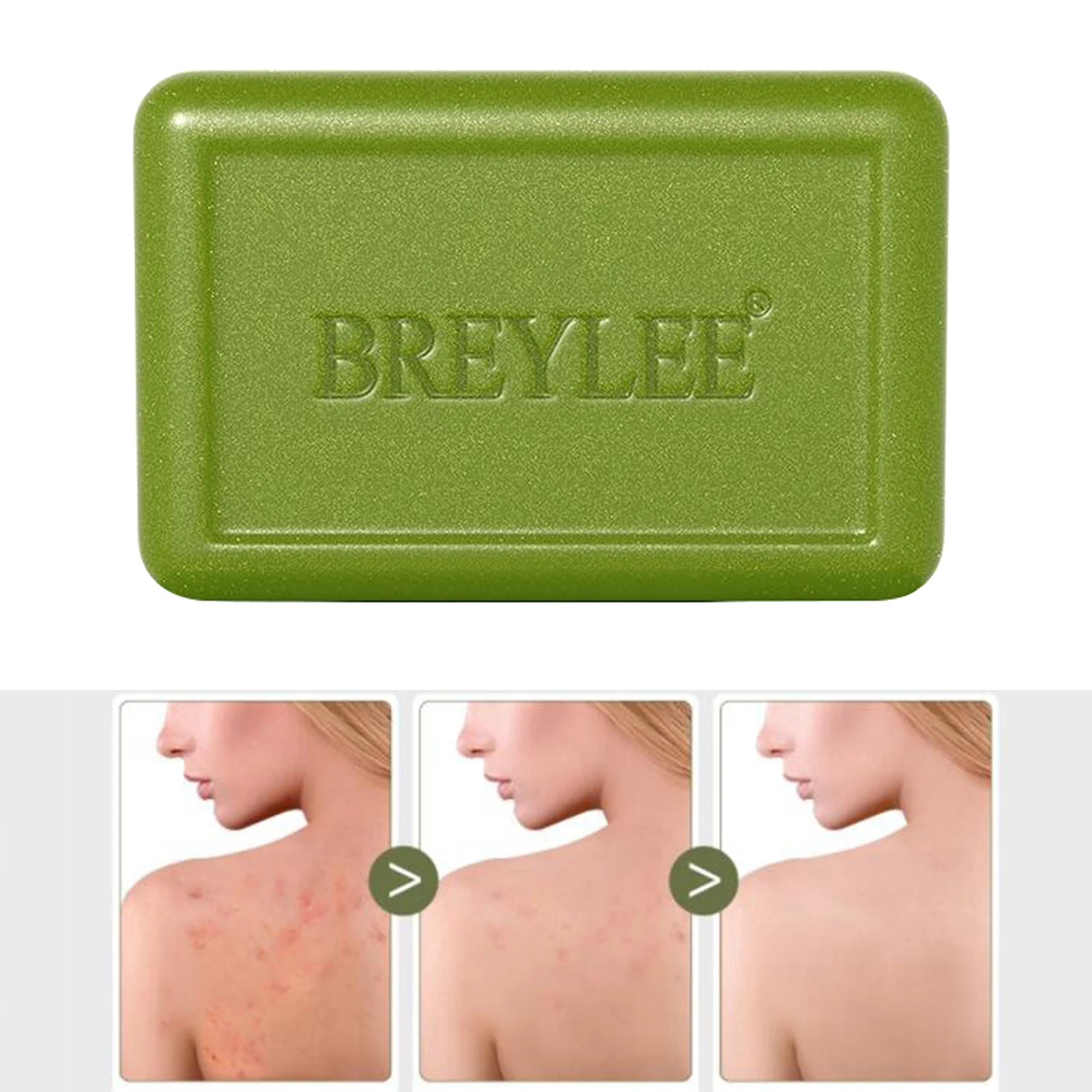 BREYLEE Acne-clearing Soap Bar Removal Oil Acne Treatment Control Moisturizing Deep Cleansing Facial Body Dry Skin Care Bath 80g