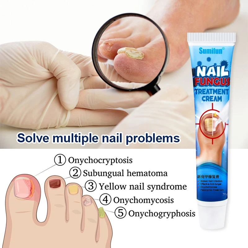 1pcs Nail Fungus Treatment Cream Onychomycosis Paronychia Herbal Antibacterial Repair Ointment Anti Fungal Feet Toe Care P1148