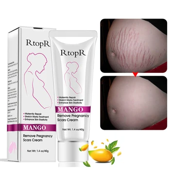 

RtopR Mango Anti-Prevention Cream Remove Pregnancy Scars Acne Cream Stretch Marks Treatment Maternity Winkles Firming Creams