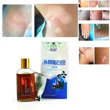 Медицинское профессиональное лечение для кожи белая пятнистая витилиго Eczema Sweatstain раствор