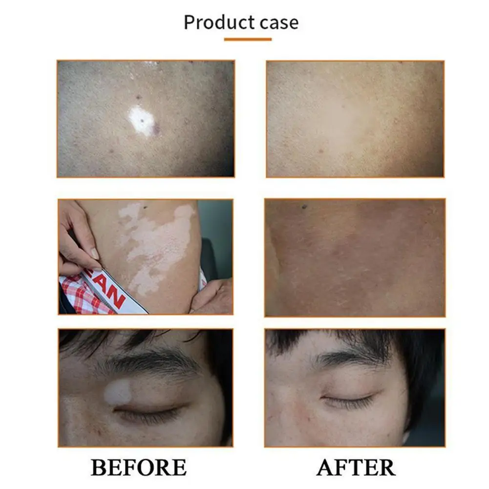 Vitiligo Leukoplakia treatment Cream ointment Chinese Herb Skin Care White Spot Disease Cream Pigment Melanin Promoting Plaster