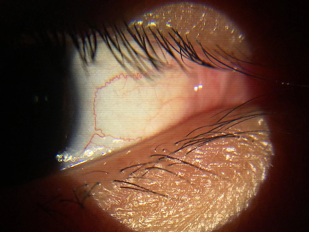 Ophthalmic Portable Slit Lamp All In One Handheld Type