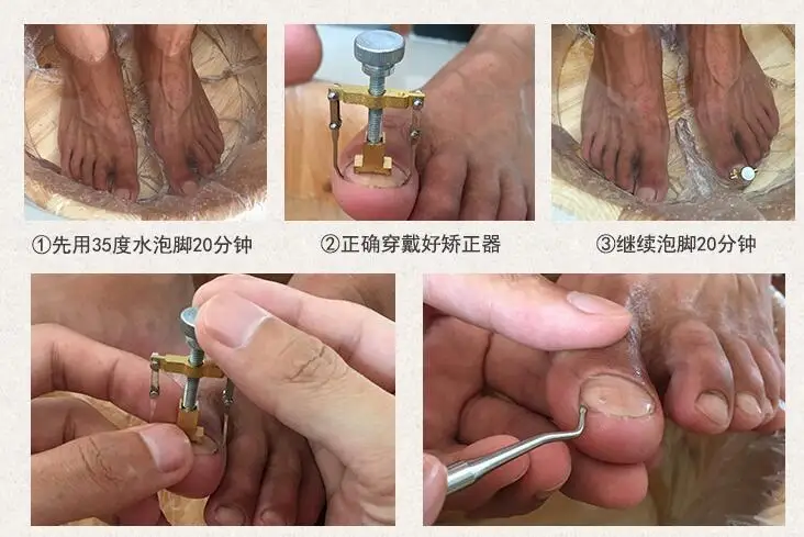 Для вросших ногтей, педикюра, инструмент для ухода за ногами, коррекция ногтей, клипер для ортодических акрионикса, удаления омертвевшей кожи Podiatry