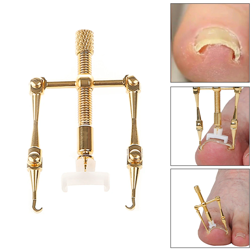 

Mini Ergonomic Nail Reshape Tools Ingrown Toe Pure Copper Nail Toe Fixer Pedicure Nail Corrector Paronychia Brace Rust Proof