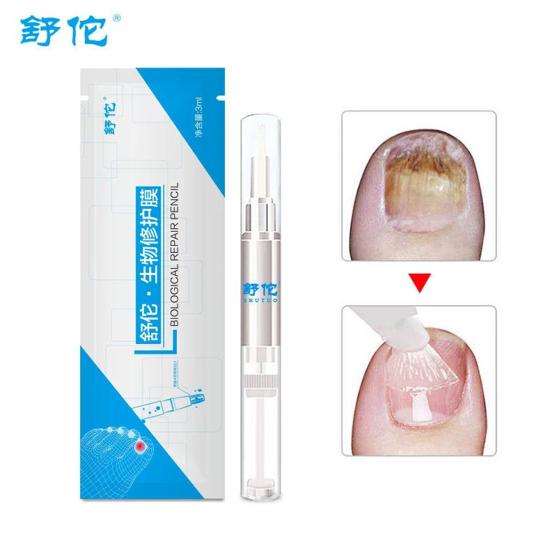 Nail Repair Tools Efficient Fungal Nail Treatment Anti Fungal Nail Infection Cream Onychomycosis Paronychia Chinese Herbal Care
