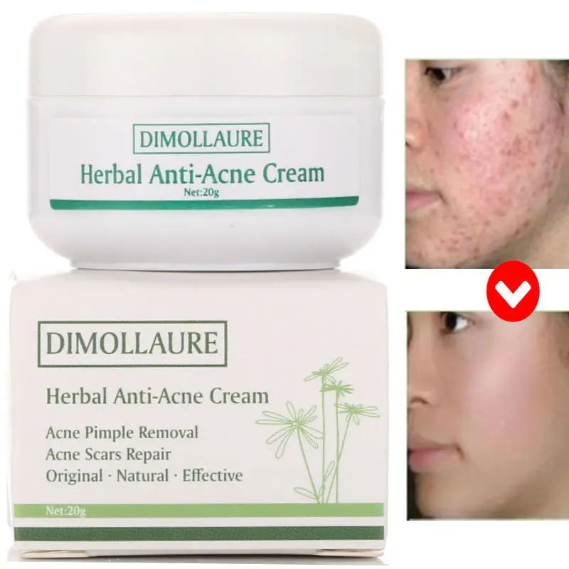 Крем для лечения акне Dimollaure увлажняющий крем лица против рубцов от контроля
