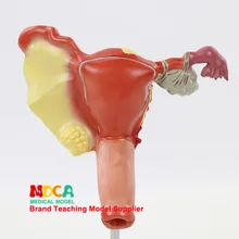 Человеческая матка патологическая оварианская патологическая половозрастная планировка семьи маточная анатомическая модель обучения медицине Mszxt004