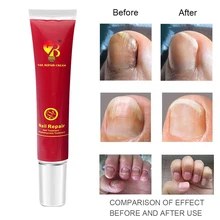 Крем для лечения грибка ногтей продукты Onychomycosis Paronychia противогрибковые инфекция ногтей китайский травяной уход масло TSLM2