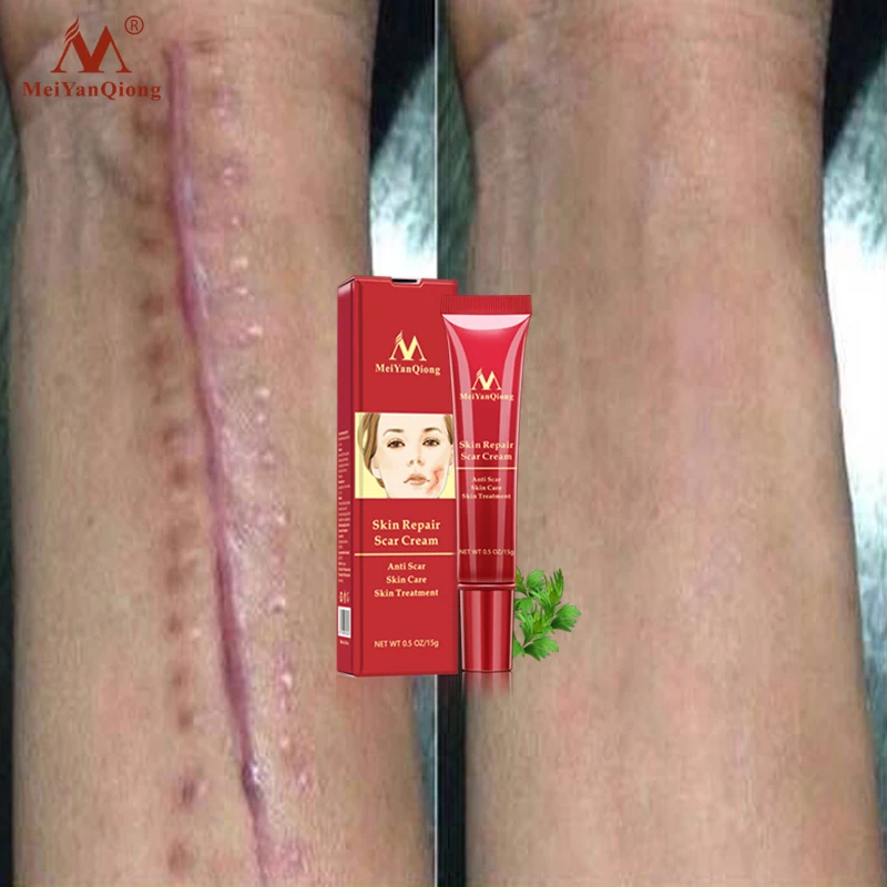 

15g Acne Removal Cream Skin Repair Face Cream Acne Acne Treatment Blackhead Whitening Cream Anti Stretch