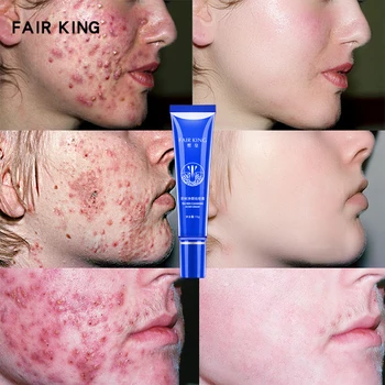 

FAIR KING Acne Treatment Blackhead Removal Anti Acne Face Cream Oil Control Shrink Pores Acne Scar Remove Face Care Whitening