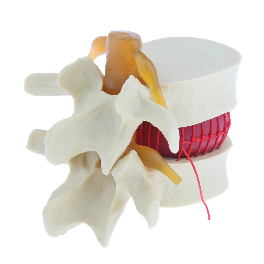 

Anatomical Herniated Lumbar Vertebrae Disc Prolapse Model Human Anatomy 1.5x Magnification