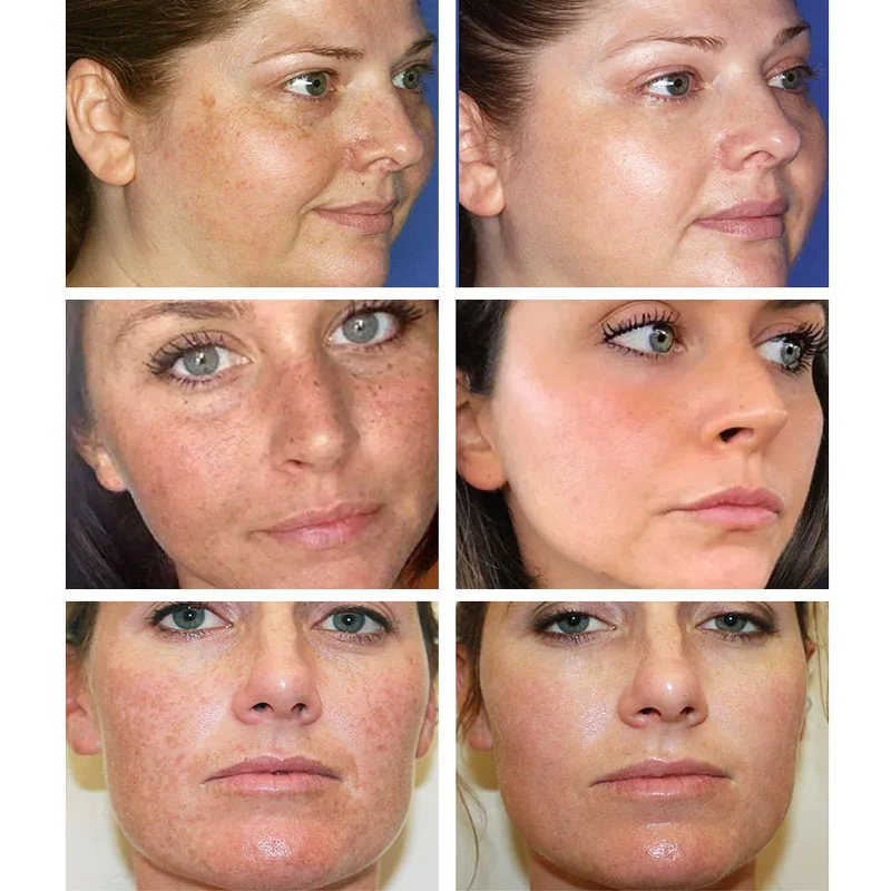 VOVA Dark Spot Remover Freckle Cream Remove Melasma Acne Spot Pigment Melanin Bleaching Dark Spots Pigmentation Whiten Skin Care