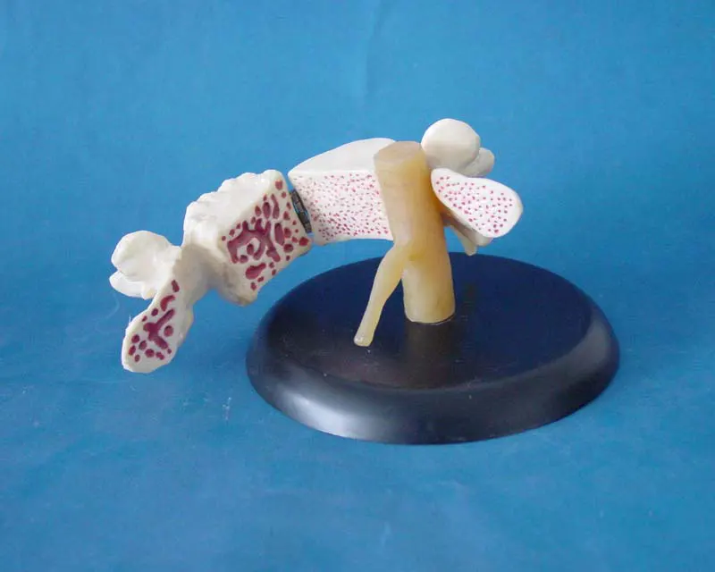 Life Size Osteoporosis Heath and Morbid State Bone Compare Models Human Spinal Spine Pathology Model Humans Skeleton |