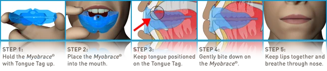 Ортодонтический тренажер для выравнивания T4/MRC Ортодонтические брекеты/Myobrace Teeth technic T4 выравнивает зубы/стоматологический тренажер для зубов