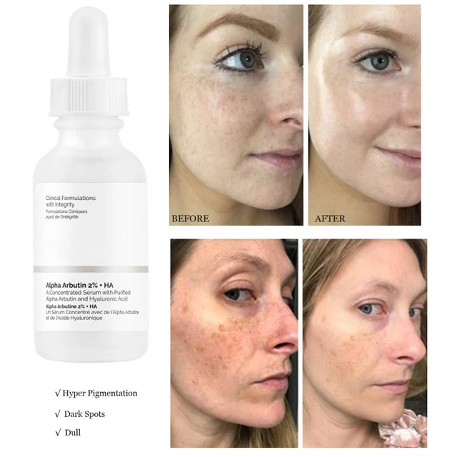 Alpha Arbutin 2%+HA Serum Moisturizing Brightening Fades Fine Lines and  Spots Facial Essence Face Skin 30ML - AliExpress
