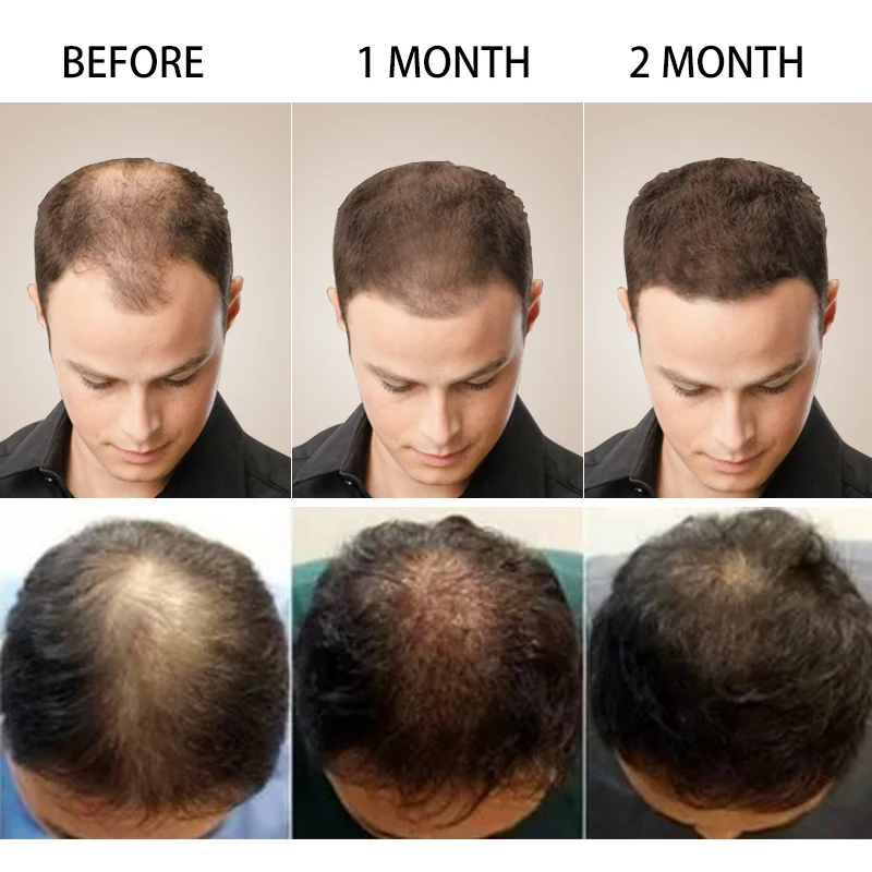 Effective Fast Hair Growth Essence Oils Advanced Thinning Hair &Hair Loss Preventing Hair Loss Baldness Serum Anti-off Hair Care Effective Fast Hair Growth Essence Oils Advanced Thinning Hair &Hair Loss Preventing Hair Loss Baldness Serum Anti-off Hair Care