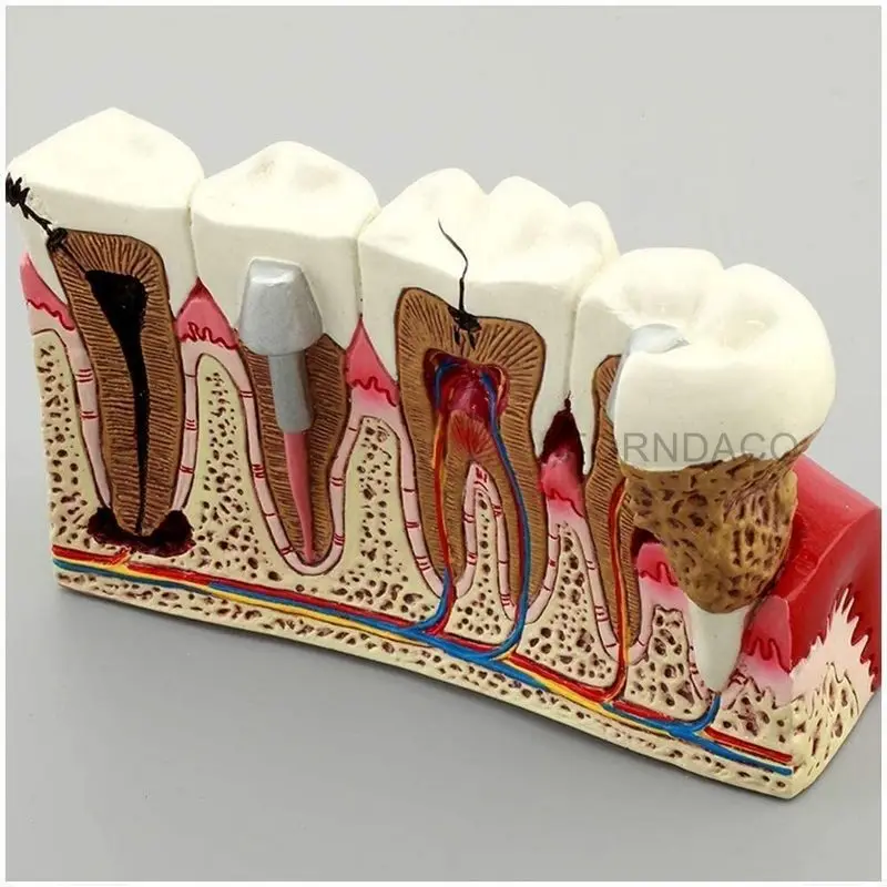 Demonstration Dental Anatomy Caries Oral Model Medical Teaching Study Communication