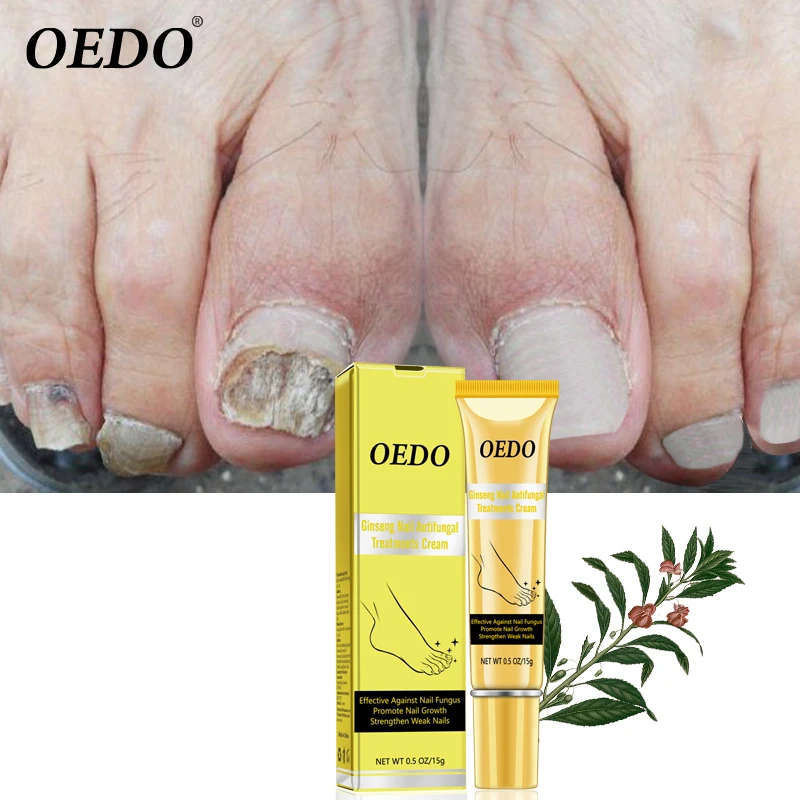 Herbal Ginseng Nail Antifungal Treatments Cream Removal Nail Fungus Toe Anti Infection Paronychia Onychomycosis Foot Care Cream
