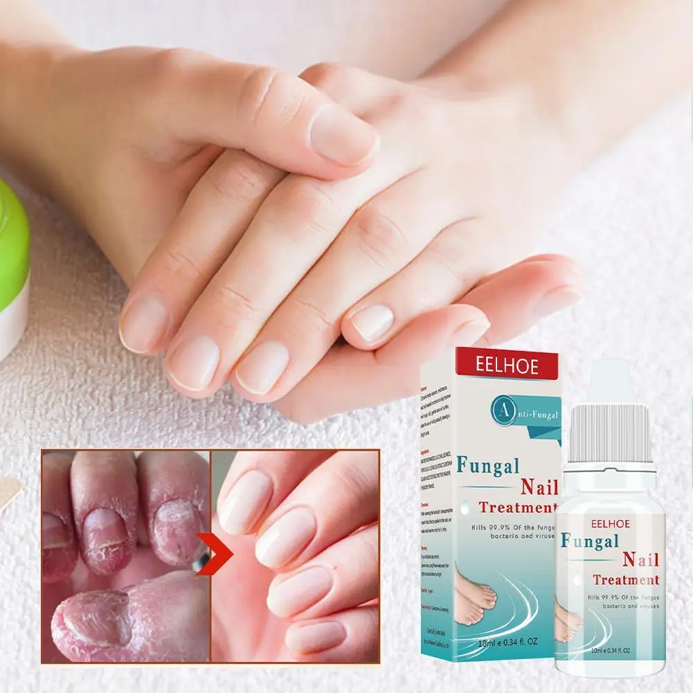 Buy AdiExpress Anti Fungal Onychomycosis Repair gel Nail Treatment Cuticle  Revitalizer Oil Best Nail Repair Solution Online at Best Prices in India -  JioMart.