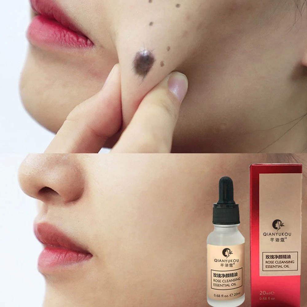 

20ML Mole & Skin Tag Repair Solution Painless Mole Skin Dark Spot Repair Face Wart Tag Freckle Repair Cream Oil D086