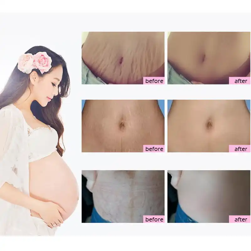 Natural Mild Non Irritating Stretch Mark Cream Pregnancy Acne Repair Scar Slack Line Abdomen Nourish Postpartum Body Skin Cream Maternity Aliexpress
