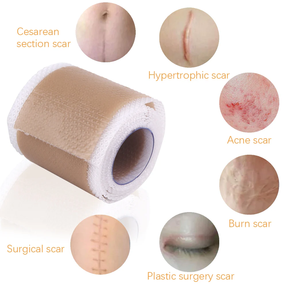 4x100cm Scar Treatment Silicone Patches Burn Acne Remove Caesarean Section Cover Surgery Wounds Ear Correctors Beauty Skin Sheet