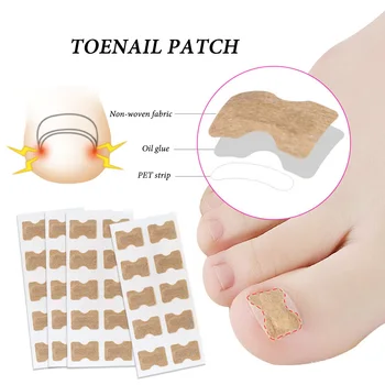 

Ingrown Toenail Corrector Sticker Paronychia Treatment Fixer Recover Corrector Pedicure Foot Toe Nail Care Tool Glue Free