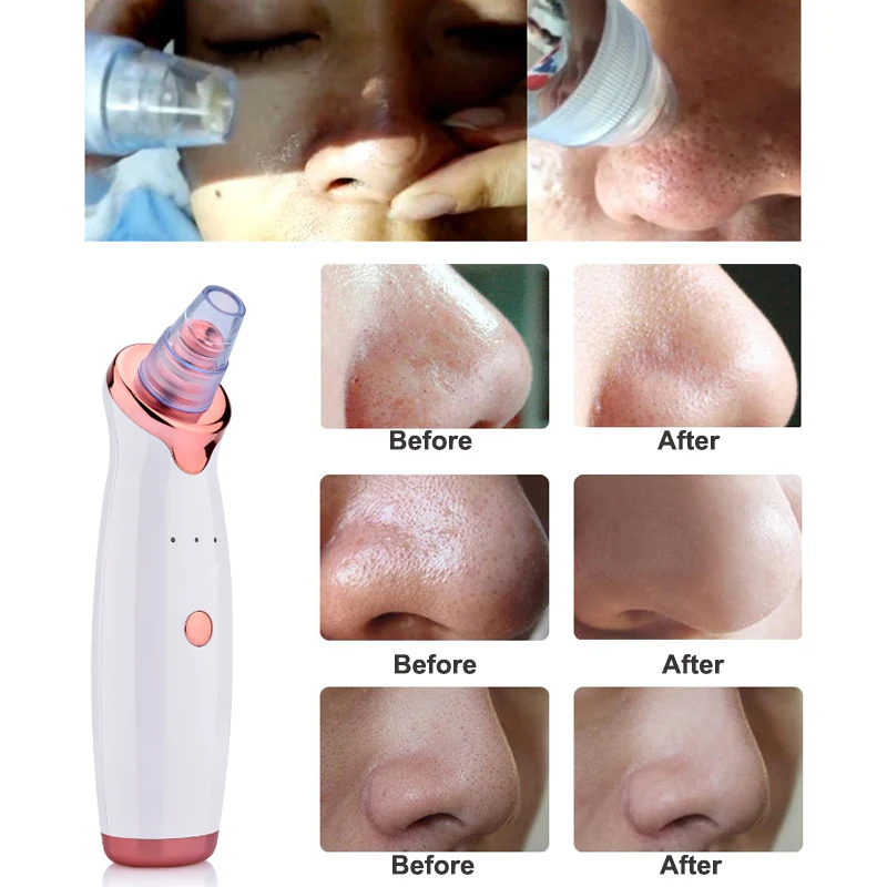 Электрический инструмент для удаления акне Noir Blackhead черных точек очиститель пор