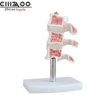 

Medical Anatomy Human Cutaway Osteoporosis Anatomical Model