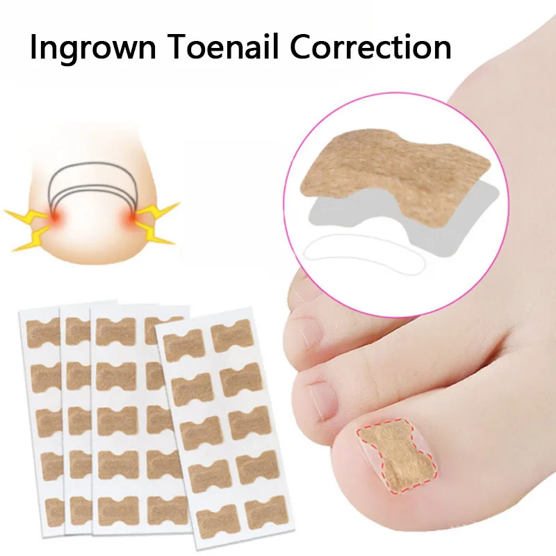 

20/50pcs Ingrown Toenail Correction Stickers Paronychia Treatment Recover Toe Nail Repair No Glue Feet Patch Corrector Pedicure