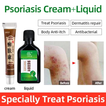 

Herbal Medicine Psoriasis Antibacterial Liquid Body Psoriasis Treatment Care Works Perfect For All Kinds Of Skin Dermatitis