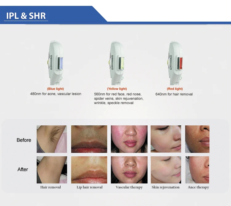 Beauty Equipment New Style Ipl Shr /opt/aft Ipl Fast Hair Removal+elight+ Rf +laser Multifunctional Shr Ipl