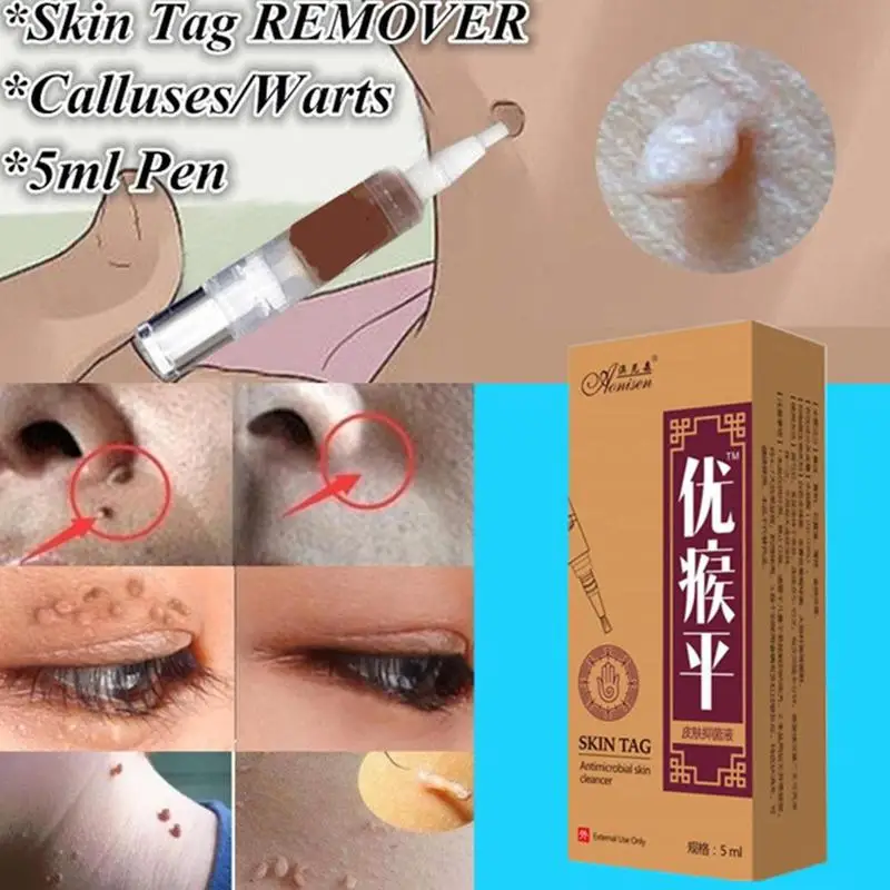 Skin Tag Remover Pen 12 hours Tu kill Medical Mole &amp Genital Wart Foot Corn Removal | Красота и здоровье