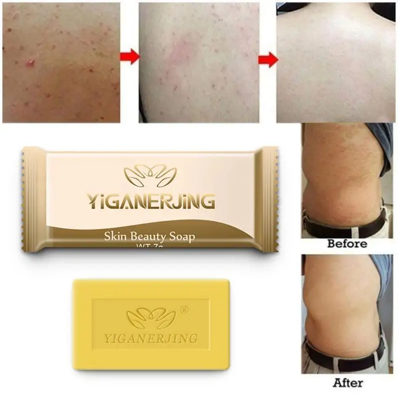 Серное мыло для кожи антибактериальное лечение угревой сыпи Eczema Анти Гриб для ванны мыло для красоты средство для удаления черных точек китайский уход за кожей TSLM2