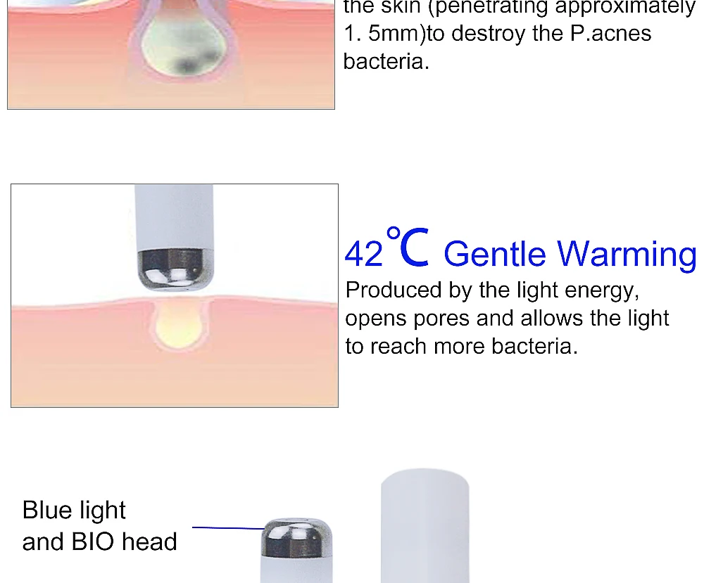 Licheng Acne Laser Pen Portable Wrinkle Removal Machine Durable Soft Scar Remover Device Blue Light Therapy Pen Massage Relax