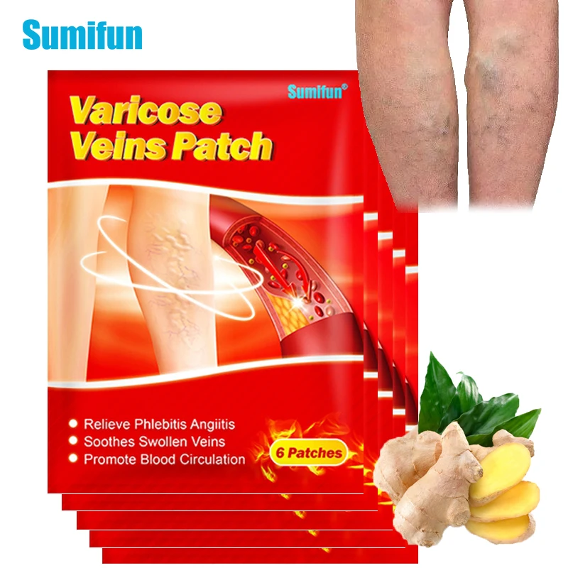 

30pcs Sumifun Varicose Veins Plaster Vasculitis Phlebitis Spider Cream Varicosity Angiitis Removal Herbal Medical Plaster K06201