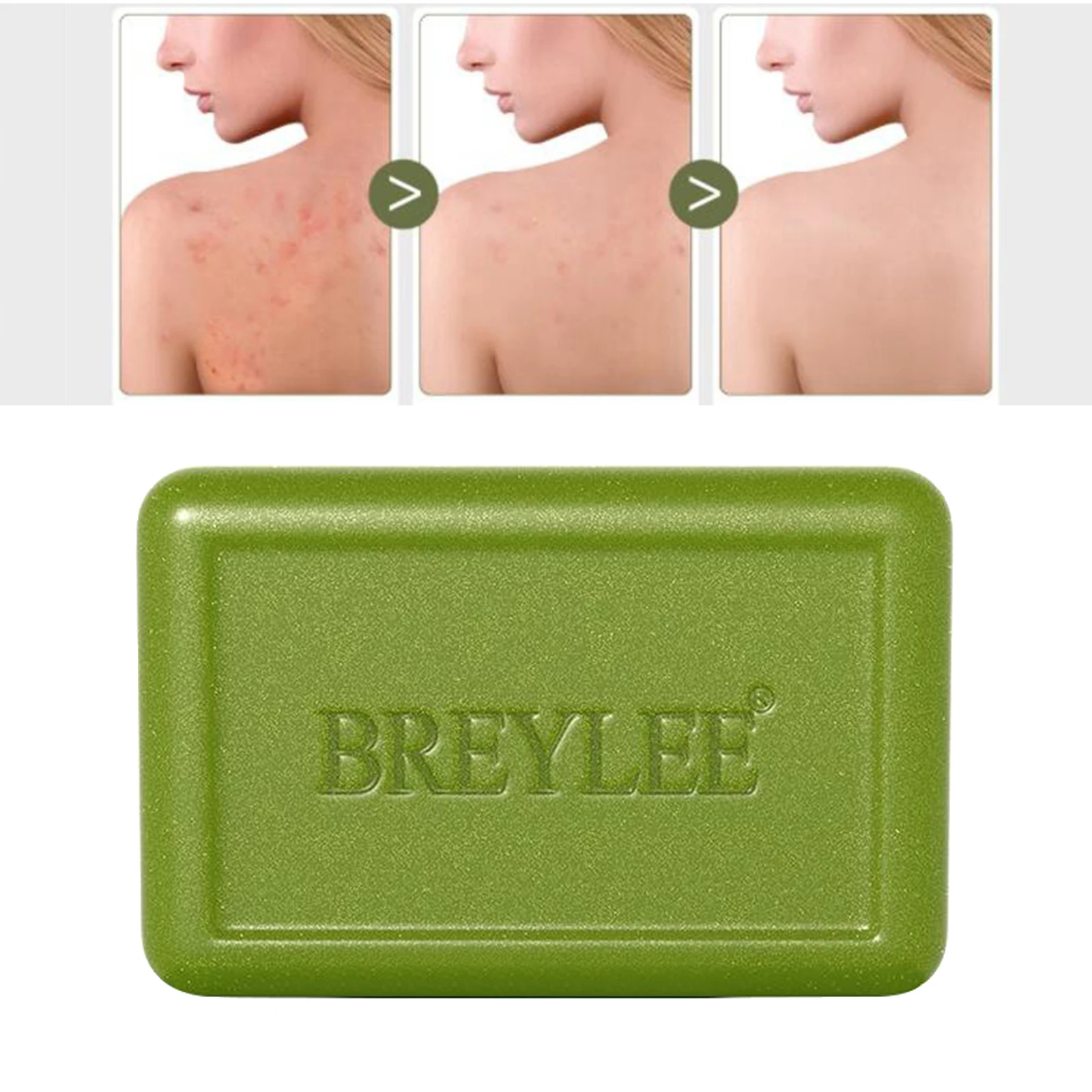 BREYLEE Acne-clearing Soap Bar Removal Oil Acne Treatment Control Moisturizing Deep Cleansing Facial Body Dry Skin Care Bath 80g