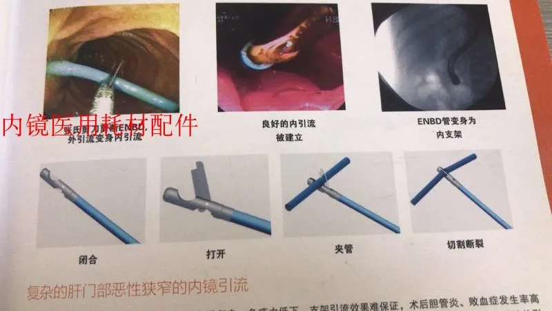 For Endoscope Foreign body pliers (Zhang's scissors) Jiuhong Full Range JHY-FG-23-180-A6(2pcs/box)