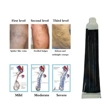 

Varicose Vein Ointment Dredge Blood Vessels Varicose Spider Veins Vasculitis Treatment Product