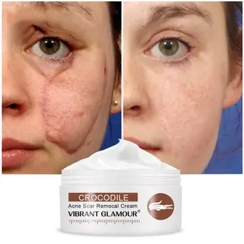 

Hotsale Crocodile Repair Acne Scar Whitening Face Cream Stretch Mark Treatment Cream